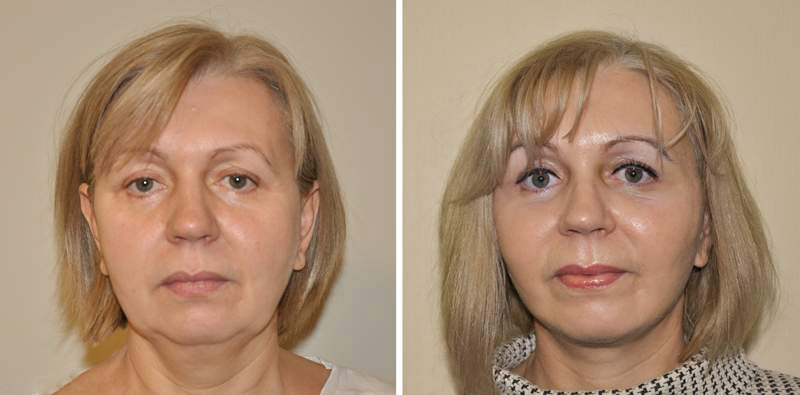 Кавитация фото до и после 1 процедуры