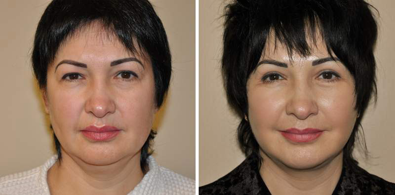 Фото До и После операции. Клиника доктора Талаевой. Опыт 25+